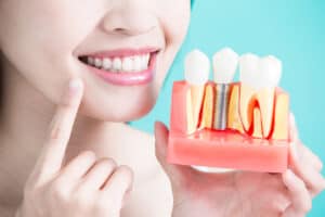 , Tips for Caring for Your Dental Implants: Ensuring Long-Term Succes