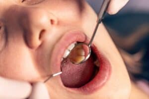 Cavities Dentist OKC