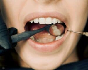 How to Stop Cavities